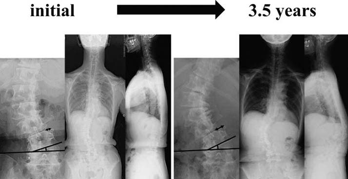 Chiropractic North Scottsdale AZ Scoliosis Xray